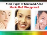 teenage acne treatment - acne treatment at home - natural cures for acne