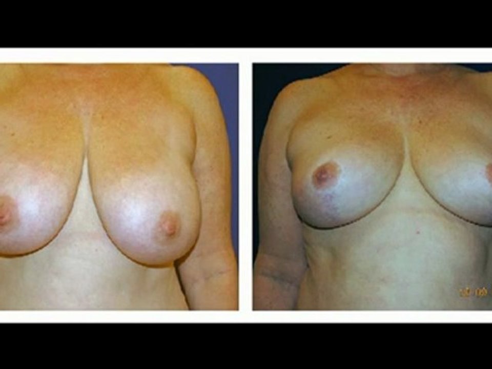 Breast_Reduction_Surgery_NY_Patient_B.mpeg