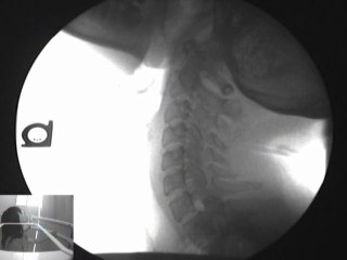 Dislocated neck missed on MRi and X-raY
