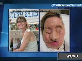 Chimp Attack Victim Reveals Photos of Face Transplant