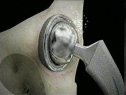 DePuy Hip Recall Lawyer - Knowing Your Rights