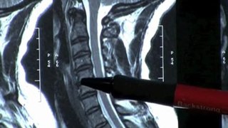 Neck Pain MRI scan Atlanta, & Spinal decompression physical therapy, chiropractor treatment
