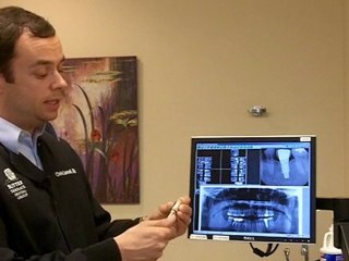 Can You Explain The Process Of Dental Implants?