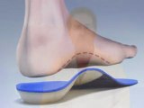 F-Scan® Pressure Analysis - Orthotic - NYC Podiatrist Manha