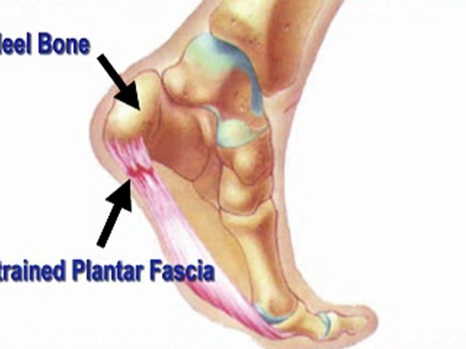 Heel Pain - NYC Podiatrist Manhattan and White Plains, NY