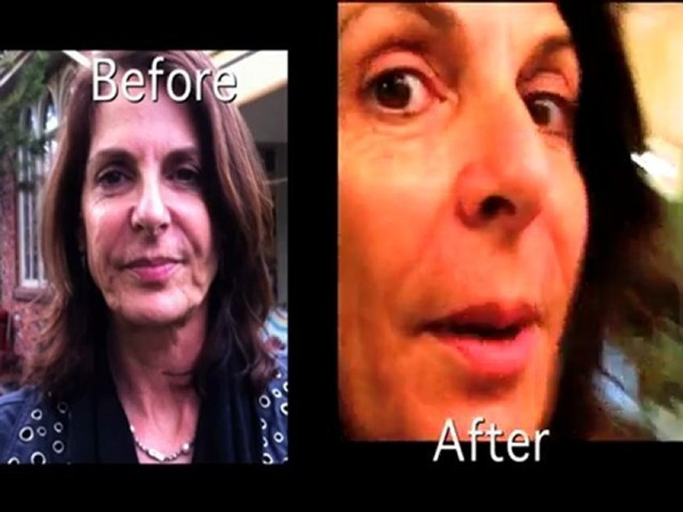 6weeks post laser