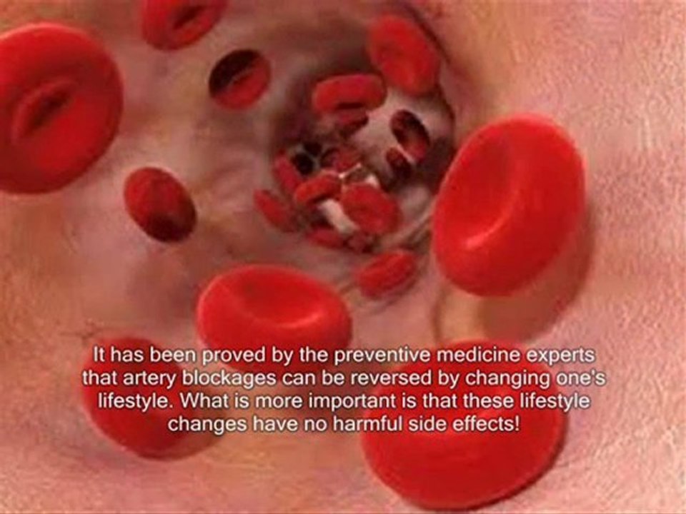 Clean plaque from arteries