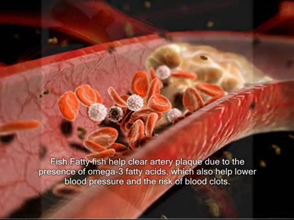 Clearing plaque from arteries