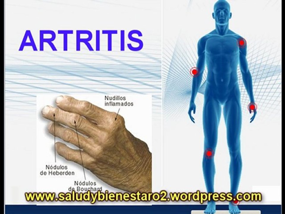 ARTRITIS, ARTROSIS NUEVO TRATAMIENTO CON OXIGENO LIQUIDO SYNERGYO2