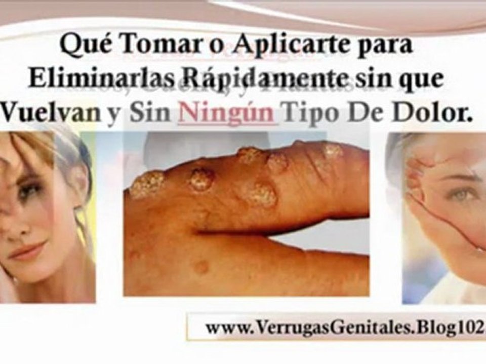 verrugas genitales en el embarazo fotos de verrugas genitales en mujeres - como se quitan las verrugas genitales