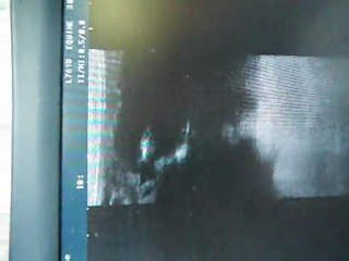 W de Fontanelle in utero