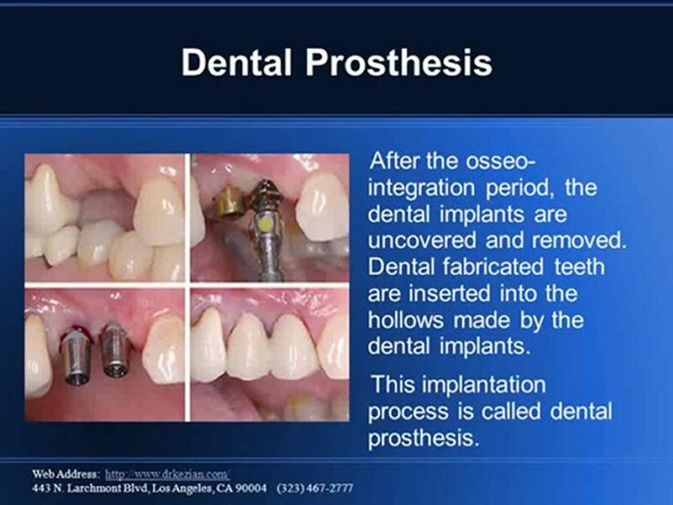 Dental Implants