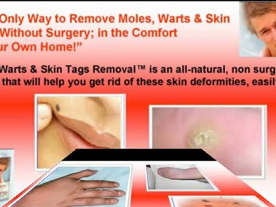 how to remove moles - how to remove skin tags - how to remove warts