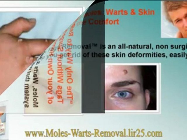 genital wart removal - genital warts treatment - cure for genital warts