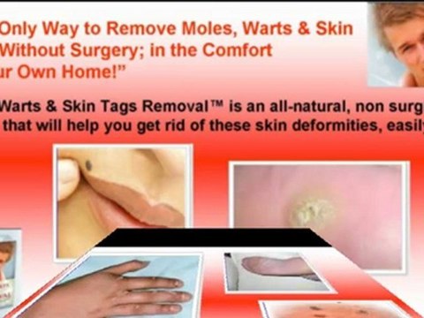 removing moles - removing skin tags - removing skin tags at home
