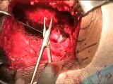 Deltamotion Rationale & Surgical Demo 3 -  Performed by Dr.Vijay C Bose