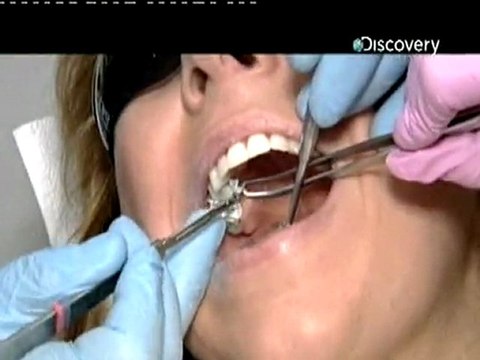 Cumhur Ogretmen Sunar DİŞ DOLGUSU Nasıl Yapılır?