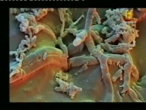 Infecciones por hongos oportunistas: Candidiasis y pie de atleta