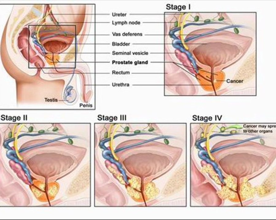 Prostate cancer symptoms would be the key to determining if one includes a chance of developing cancer of the prostate