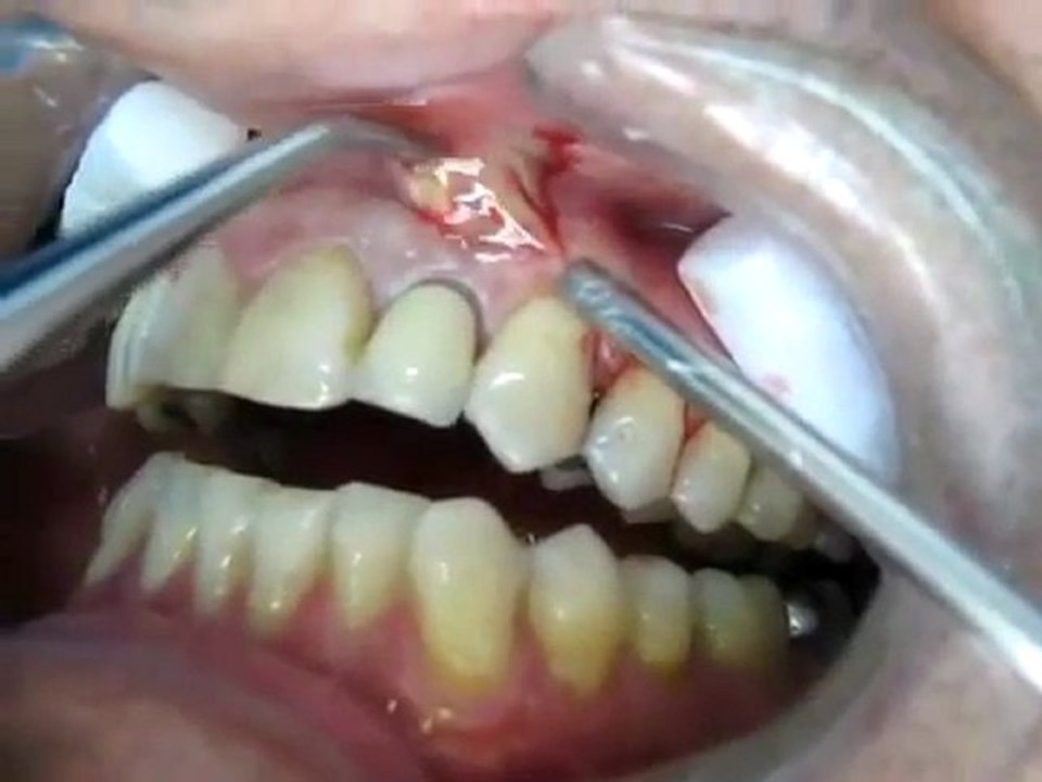 Découvrez la vidéo choc d’un dentiste lors d’une opération où il perce un abcès dentaire !