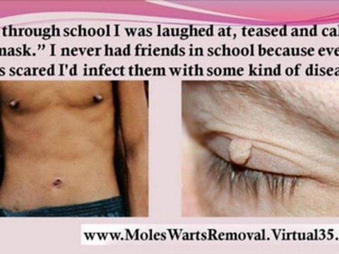 removing moles from face - remove skin tags at home - skin tags home remedies