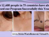 removing skin tags yourself - how to treat warts - natural wart removal
