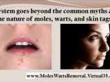 skin tags during pregnancy - home remedies for skin tags