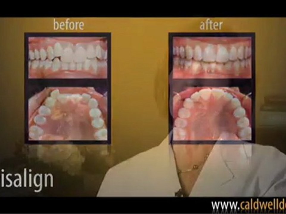 Invisalign® Clear Braces - Caldwell DDS - Orange County, California