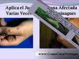 quitar verrugas remedios caseros