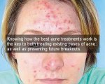 acne treatments that work