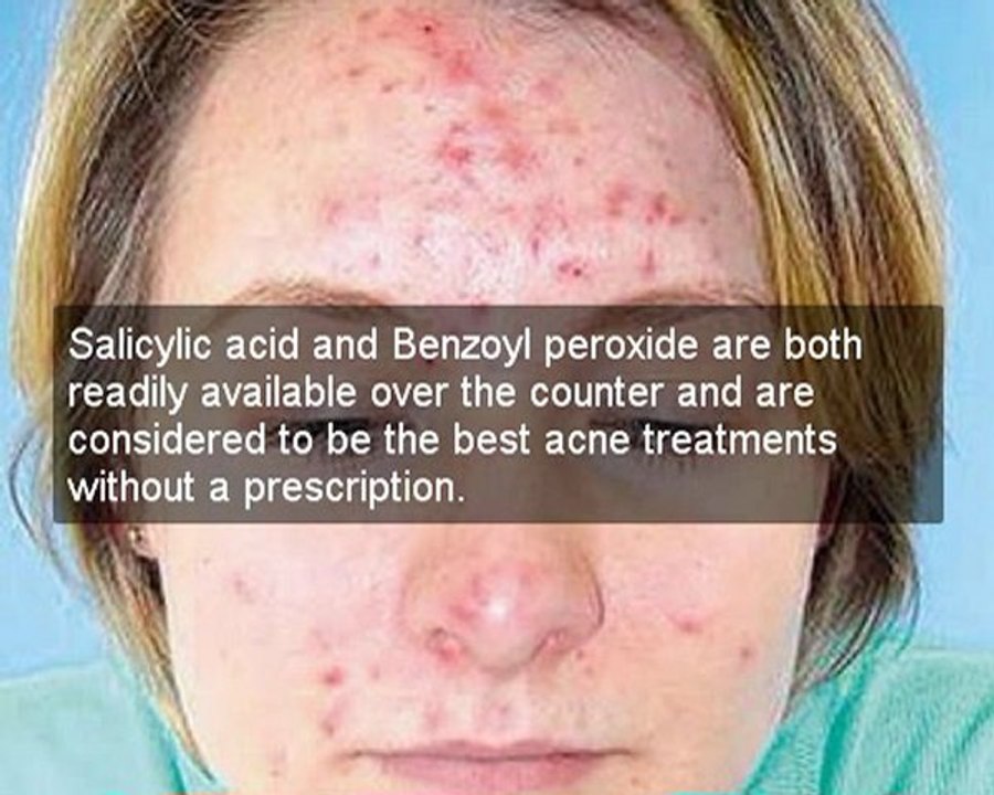 acne scar cream