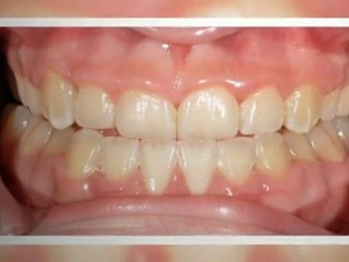 Orthodontist Parker CO - New Smiles!