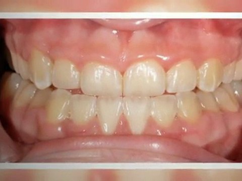 Orthodontist Parker CO - New Smiles!