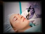 Eradicate Acne with Acne Scar Laser Treatment!