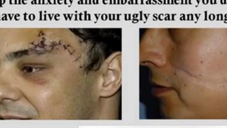 scar removal cream - acne scar remedies - best scar treatment