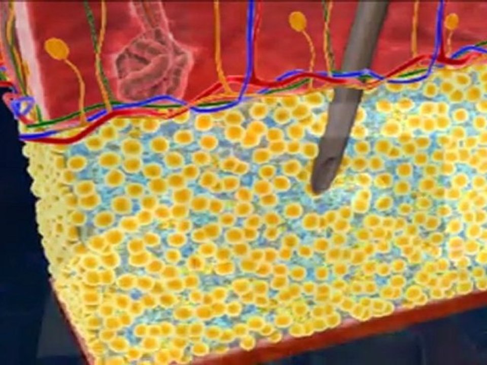 Liposuction