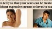 acne scar remedies - chicken pox scar - scar solution