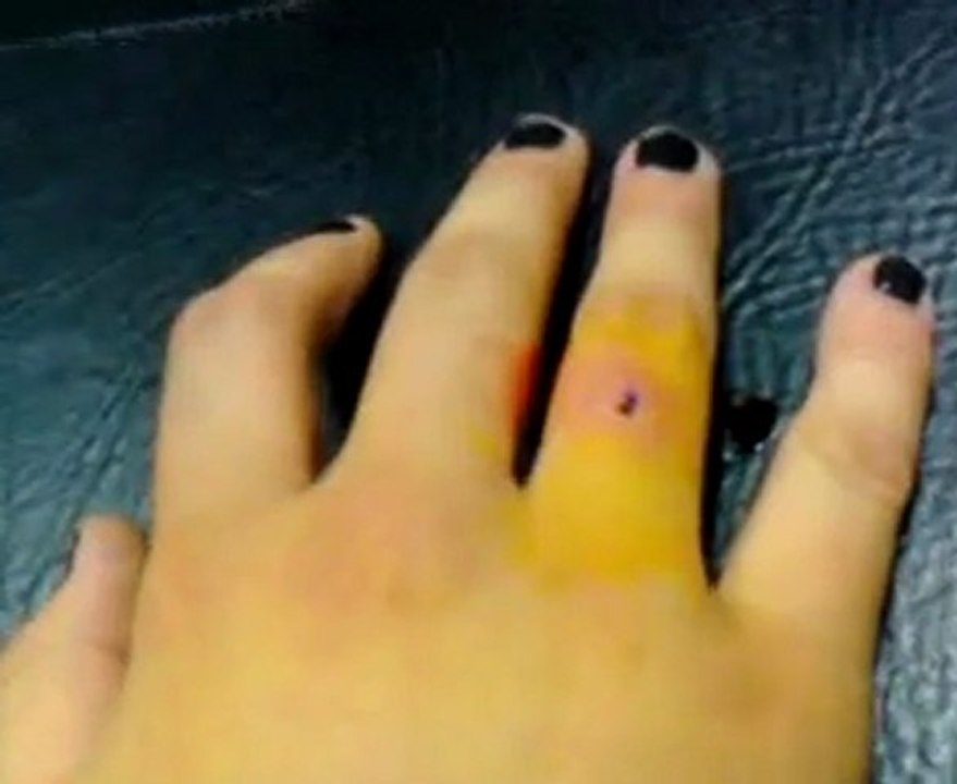 Finger Dermal