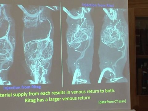 GB: quatre opérations successives pour séparer des siamoises