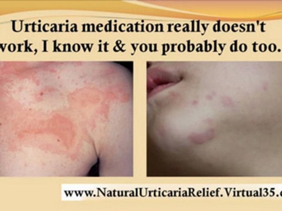 urticaria allergy - urticaria cholinergic - urticarial wheals - urticaria homeopathy