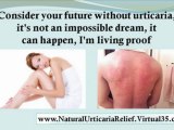 stress urticaria - urticaria in pregnancy - acute urticaria treatment - rash urticaria