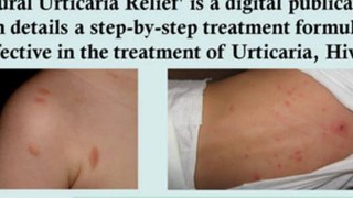 papular urticaria treatment - pruritic urticarial papules - delayed pressure urticaria