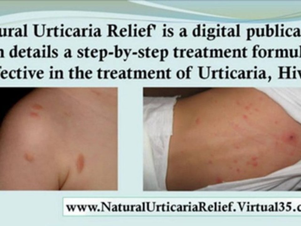 papular urticaria treatment - pruritic urticarial papules - delayed pressure urticaria