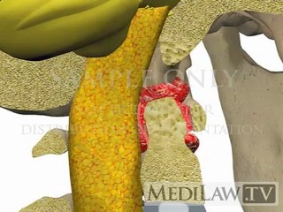 Cervical Spine Pathology Rheumatoid Cranial Settling Superior Migration Odontoid physiotherapy videos