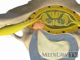 Cervical Spine Pathology Inter-vertebral Disc Sequestration rheumatologist 3D animations