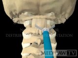 Cervical Spine Atlantoaxial Transarticular Screw Fusion Fixation surgical fusion 3D animations