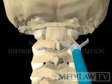 Cervical Spine Atlanto-axial Transarticular Screw Fusion Fixation with drill guide orthopaedic surgery illustrations