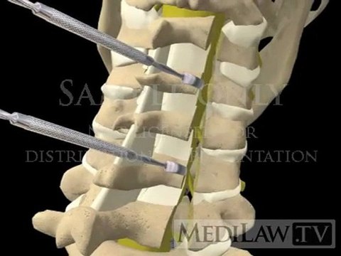 Cervical Spine Laminoplasty with bone neuro-surgeon 3D animations