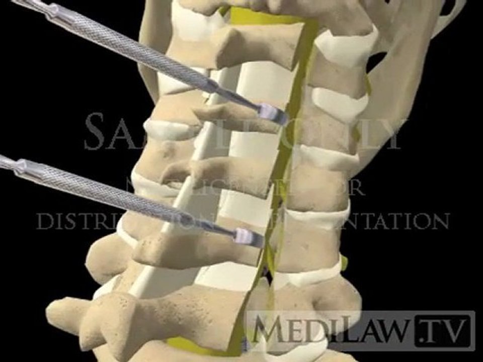Cervical Spine Laminoplasty with bone neuro-surgeon 3D animations