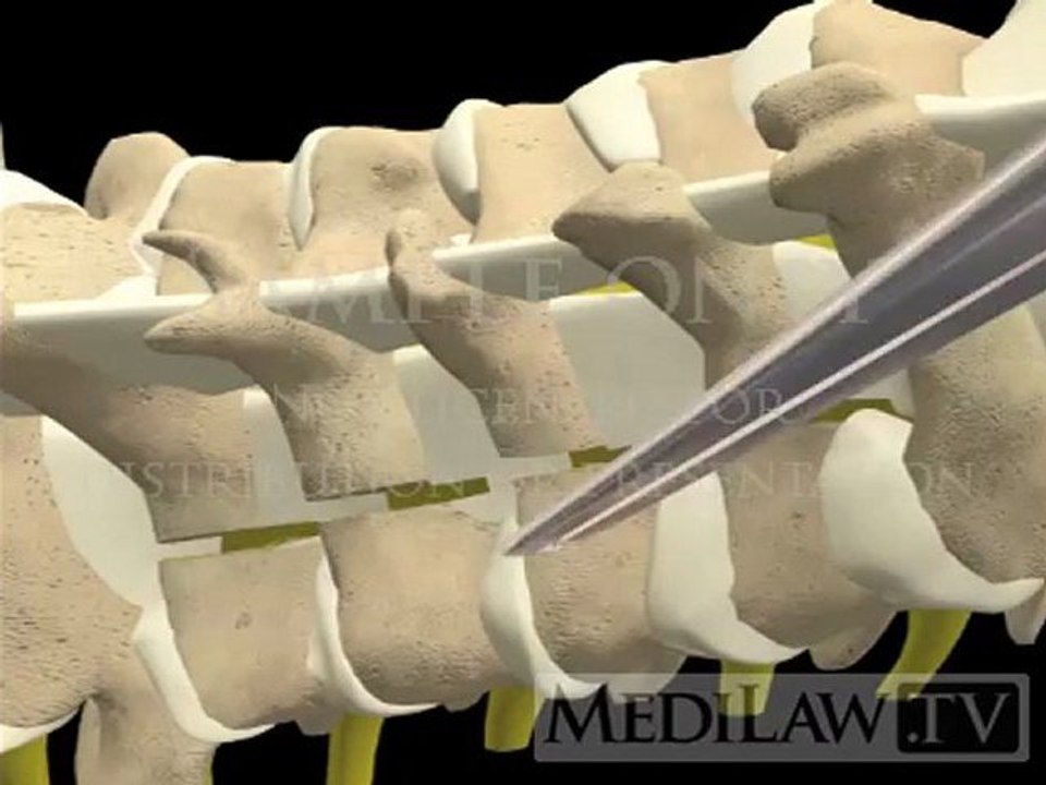 Cervical Spine Laminectomy neuro-surgery 3D animations